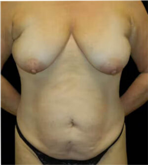 Breast Lift