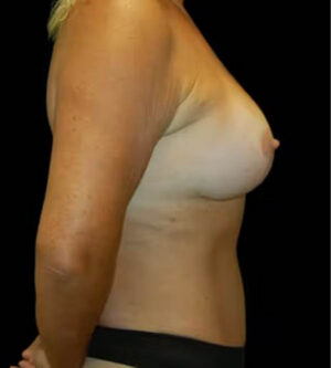 Breast Lift