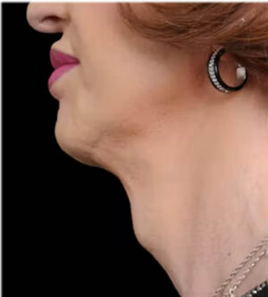 Facial Feminization Surgery (FFS)