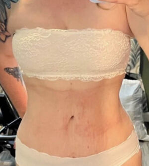 Tummy Tuck