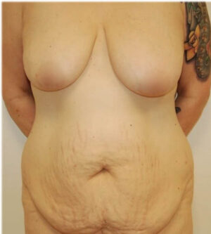 Tummy Tuck