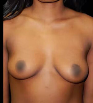 Breast Augmentation