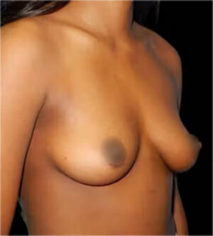 Breast Augmentation