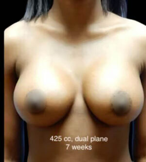 Breast Augmentation