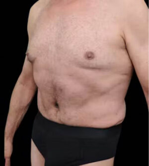 Tummy Tuck