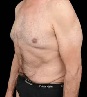 Tummy Tuck