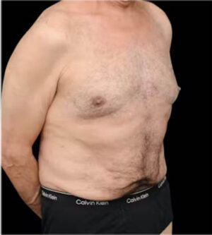 Tummy Tuck