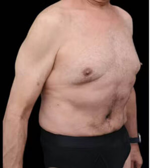 Tummy Tuck