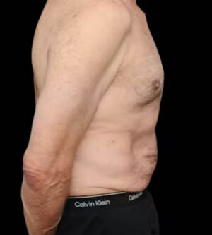 Tummy Tuck