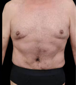 Tummy Tuck