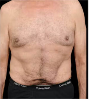Tummy Tuck