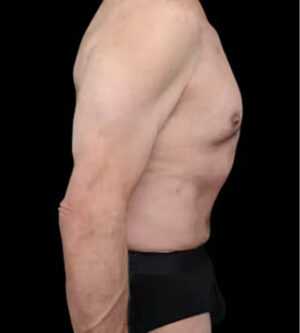 Tummy Tuck