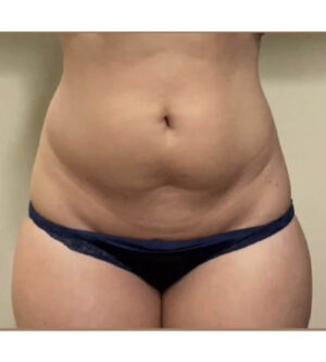 Liposuction