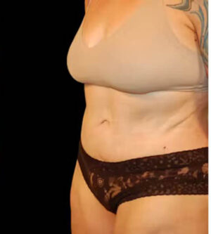 Tummy Tuck