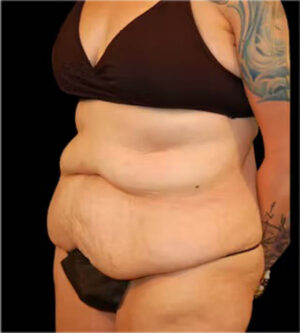 Tummy Tuck
