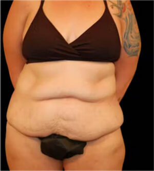 Tummy Tuck