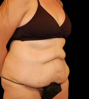 Tummy Tuck