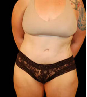 Tummy Tuck