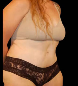 Tummy Tuck
