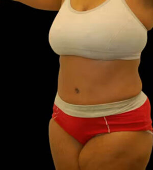Tummy Tuck