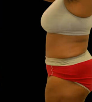 Tummy Tuck