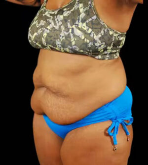 Tummy Tuck