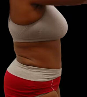 Tummy Tuck
