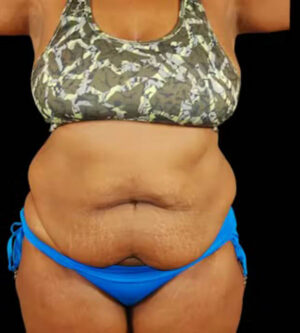 Tummy Tuck