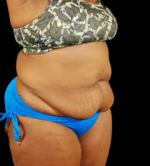 Tummy Tuck