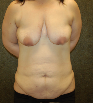Breast Lift