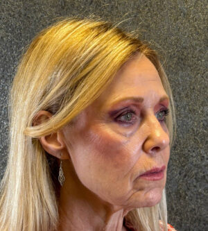 Eyelid Surgery