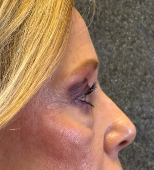 Eyelid Surgery