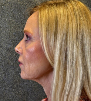 Eyelid Surgery