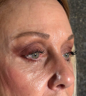 Eyelid Surgery