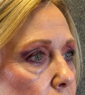 Eyelid Surgery