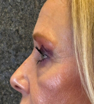 Eyelid Surgery