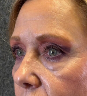 Eyelid Surgery