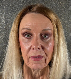 Eyelid Surgery