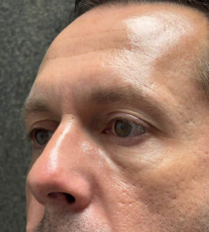 Eyelid Surgery