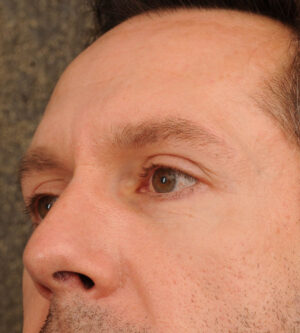 Eyelid Surgery