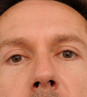 Eyelid Surgery