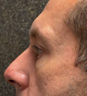 Eyelid Surgery