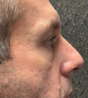 Eyelid Surgery