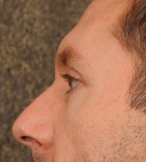 Eyelid Surgery