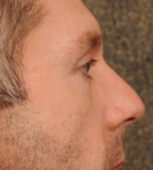 Eyelid Surgery