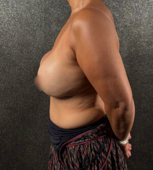 Breast Lift