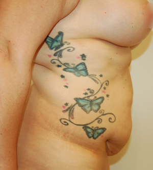 Liposuction