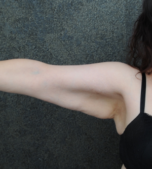 Arm Lift