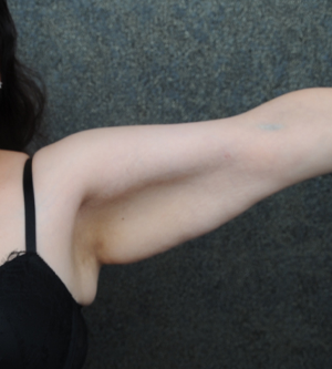 Arm Lift