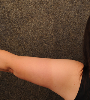 Arm Lift